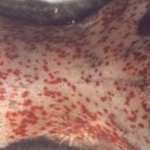 Plague disease symptoms, causes, treatment and prevention guide